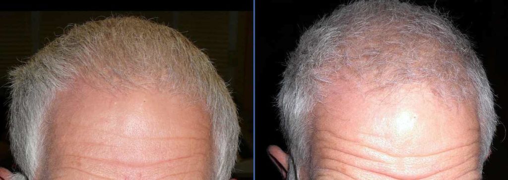 Facts About Hair Loss and Hair Restoration